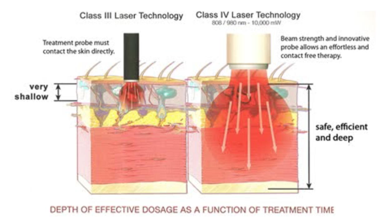 Aspen Class 3 Laser treatment